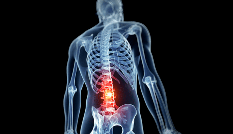 tổn thương cột sống thắt lưng trong bệnh hoại tử xương