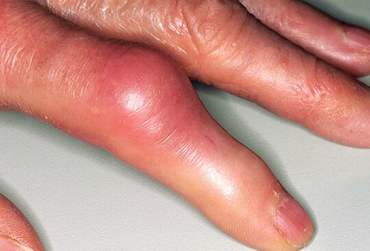 Bệnh gút kèm theo những cơn đau nhói ở ngón tay và sưng khớp. 