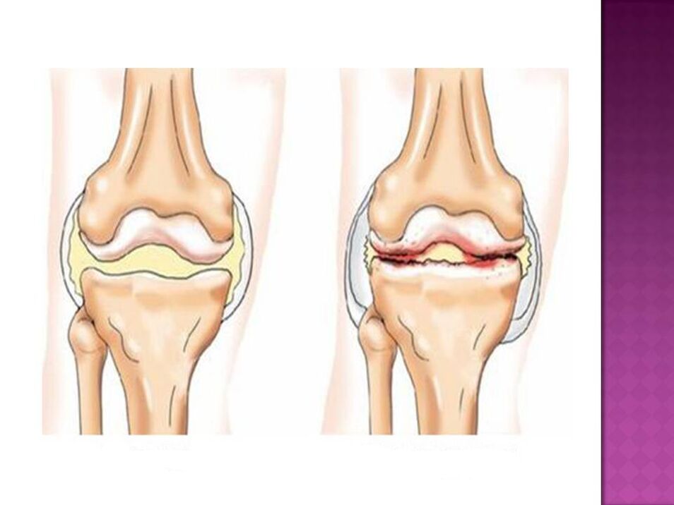 Khớp bình thường (trái) và bị ảnh hưởng bởi viêm xương khớp (phải)