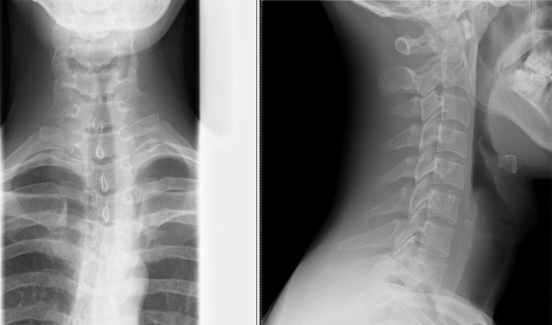 Chụp X-quang cột sống là phương pháp chẩn đoán thoái hóa khớp đơn giản và hiệu quả