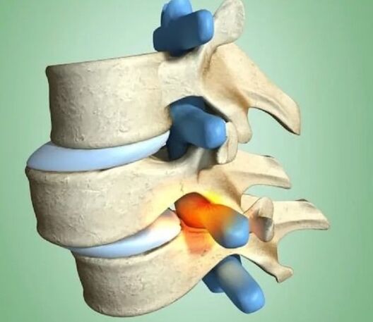 Vị trí không ổn định của đốt sống